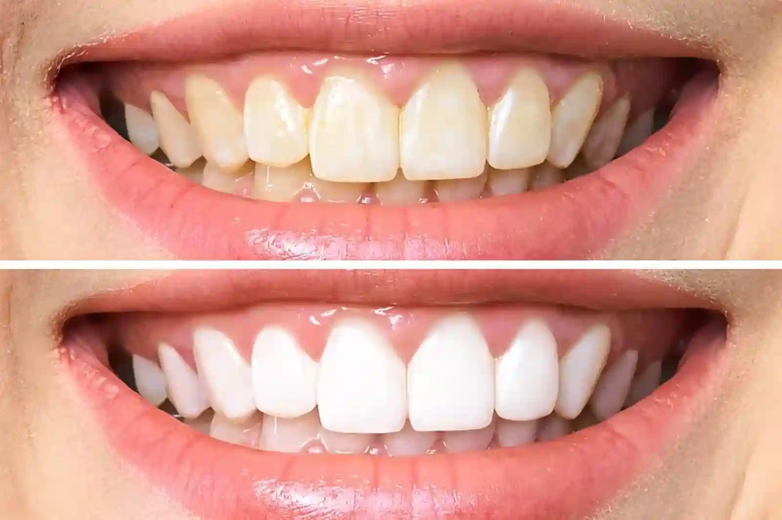 Can Professional Whitening Reverse Years of Staining in Just One Hour Harlow