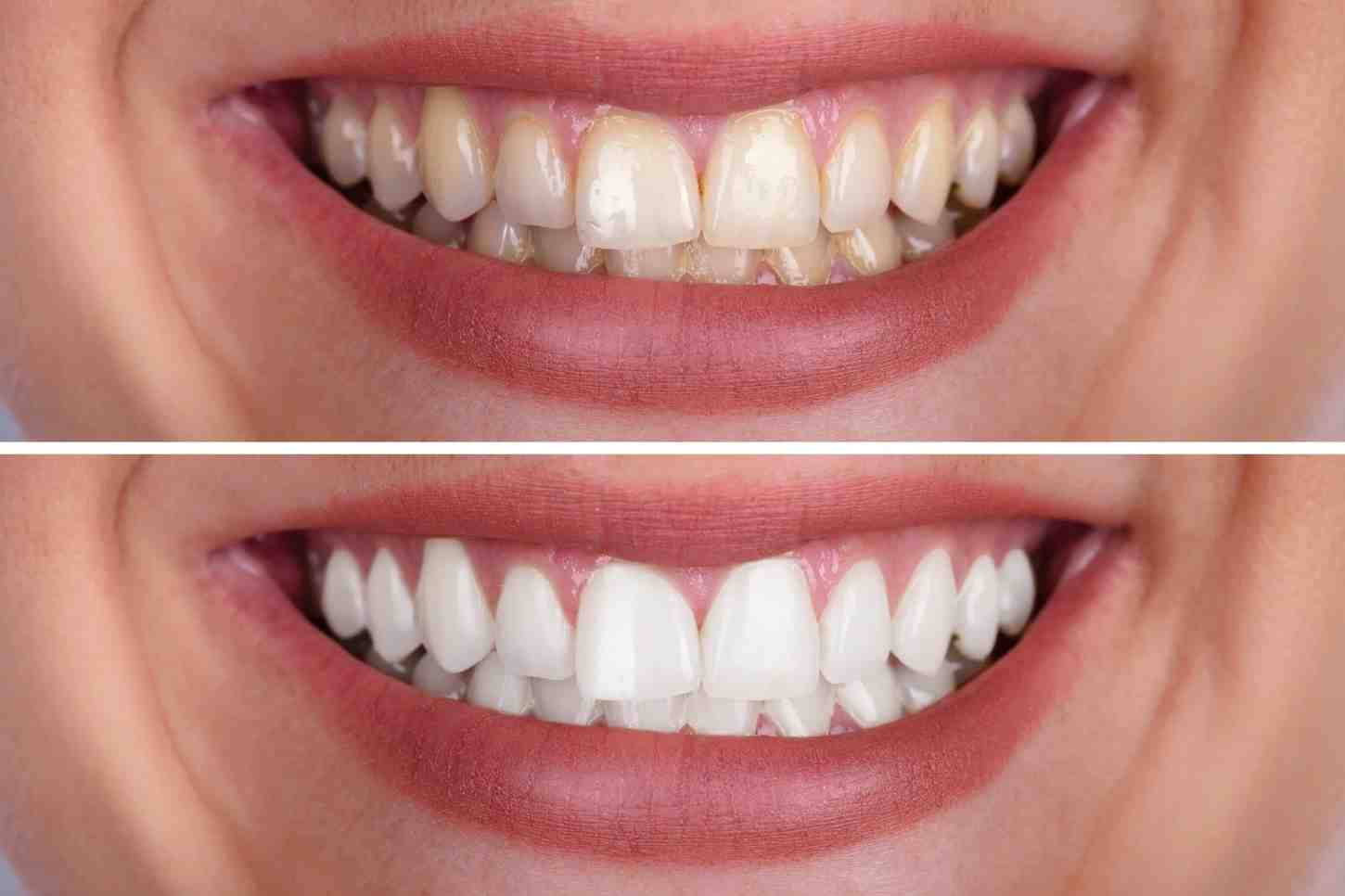 Can You Maintain That Sparkling White Smile Afterwards Harlow