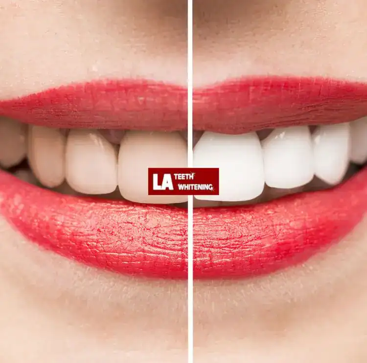 1 Hour Teeth Whitening in Harlow Harlow