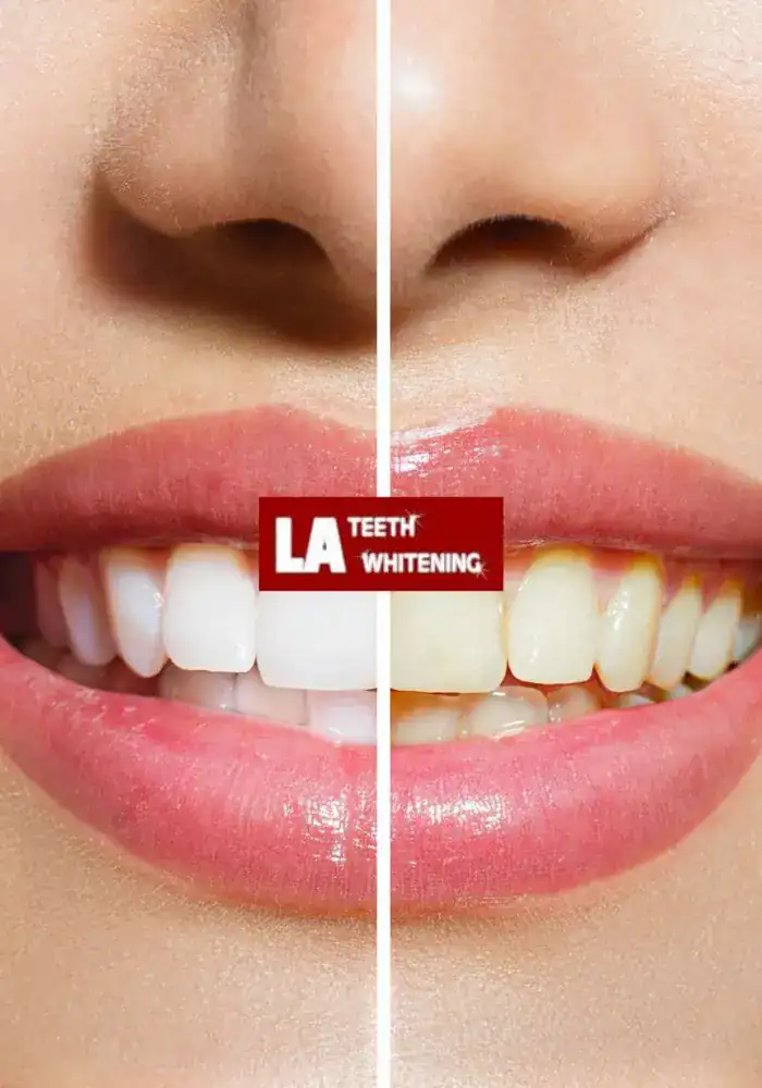 What are the common mistakes to avoid when matching whitening and restorations Harlow
