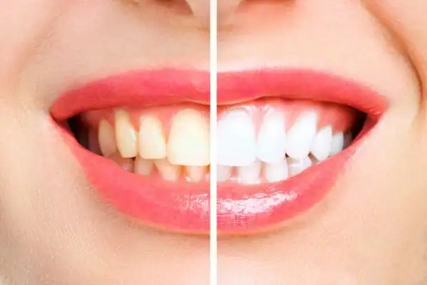 Can Professional Whitening Reverse Years of Staining in Just One Hour Harlow