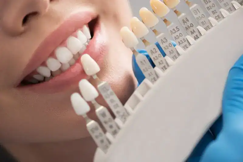 How To Match Your Crown Or Veneer Shade After Whitening Natural Teeth Harlow