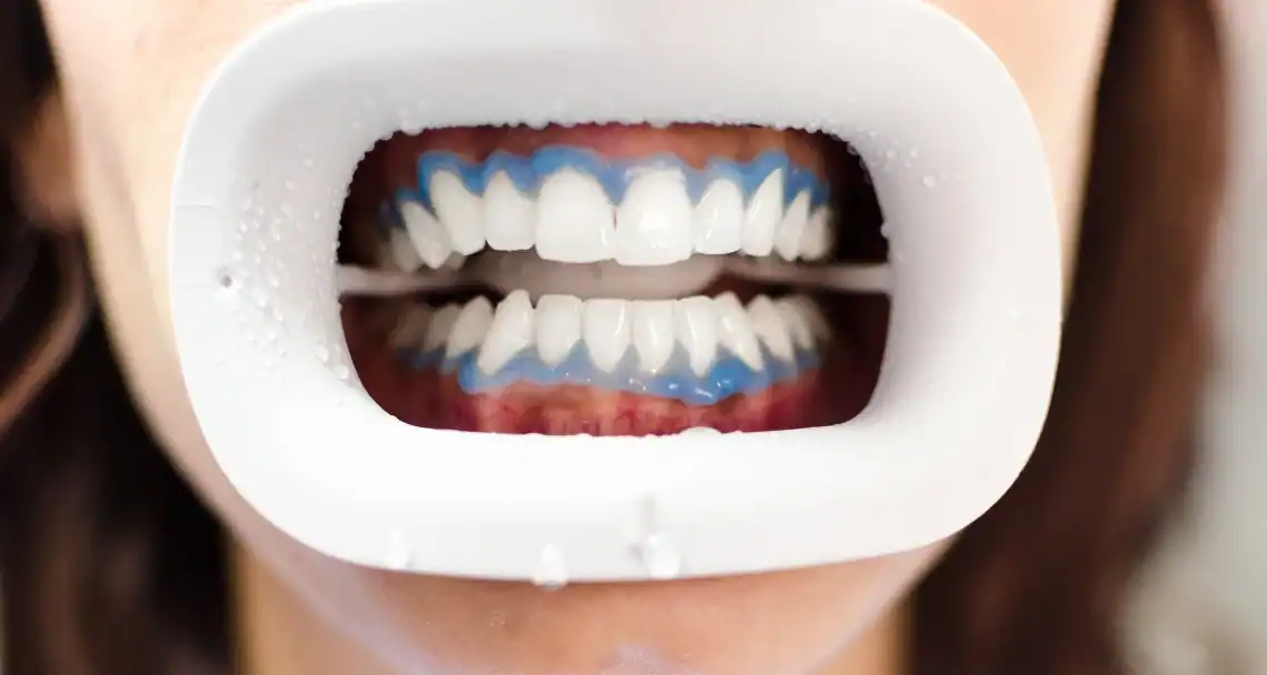 How Can You Keep Both Natural Teeth and Restorations Looking Bright Harlow